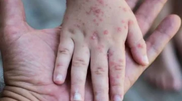 الحساسية الحشرية والجدري المائي كيف تميز بين الطفح الجلدي في الوجه والأطراف؟ 1